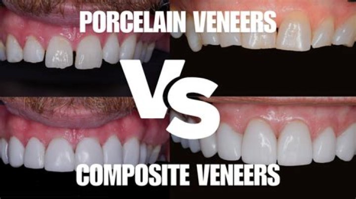 Are porcelain veneers toxic?