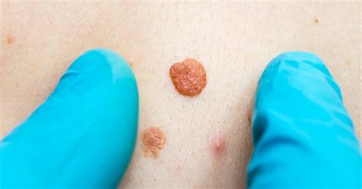 Can a skin tag be cancerous?