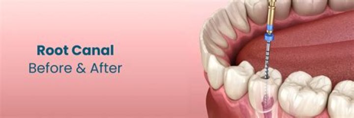 Can you cure a root canal naturally?