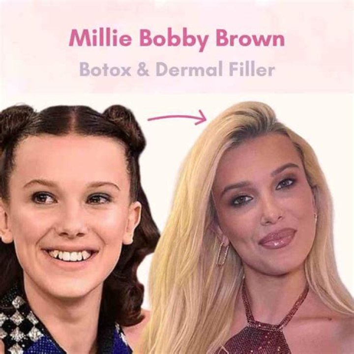 Did Millie Bobby Brown Got Botox? Her Face Surgery Before And Photos & Nose Job Explored