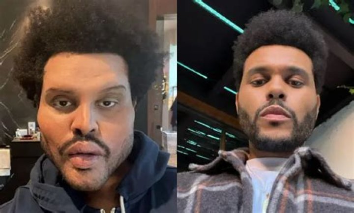 Did The Weeknd Seriously Get Plastic Surgery? His Extreme New Look, Explained