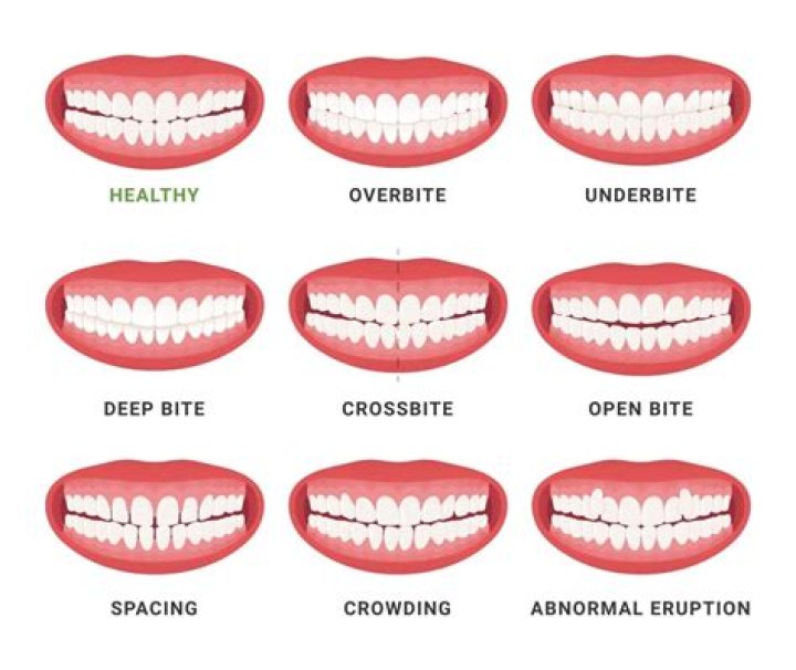 Does overbite affect smile?