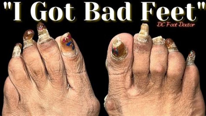 EWShaquille O’Neal Is Not the Only Celebrity With Really, Really Bad Feet!