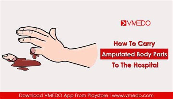 How long can an amputated body part survive?