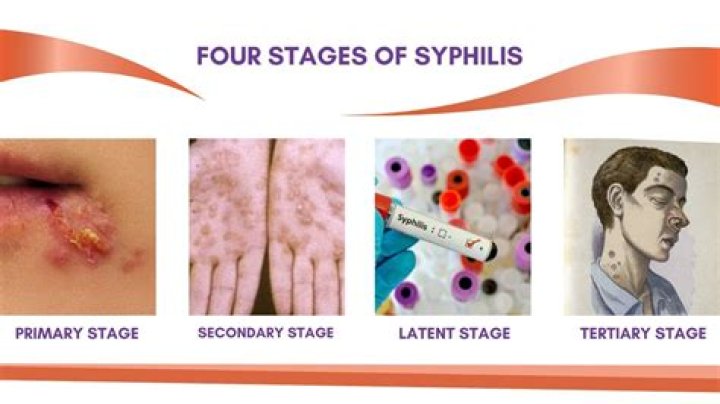 How long can syphilis lay dormant?