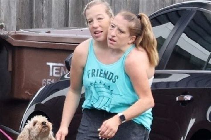 How many breasts do the Hensel twins have?