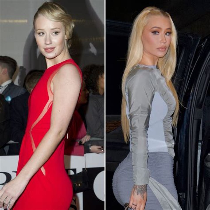 Iggy Azalea’s “Buns” Look Bigger Than Ever — and Fans Are Convinced She Got More Plastic Surgery