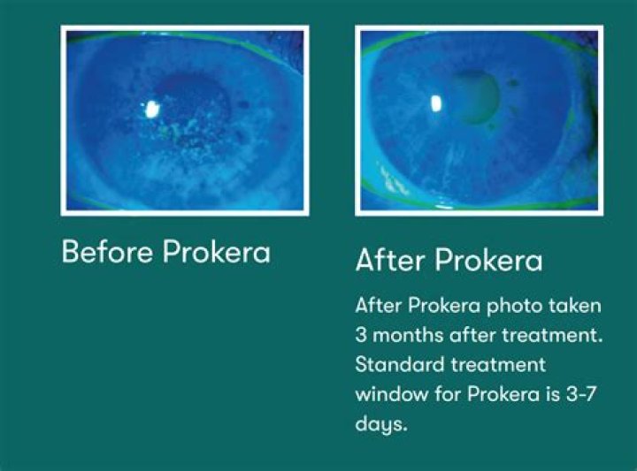 Is Procera good for you?