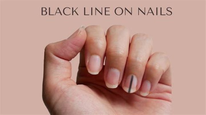 What does a black line on your nail mean?