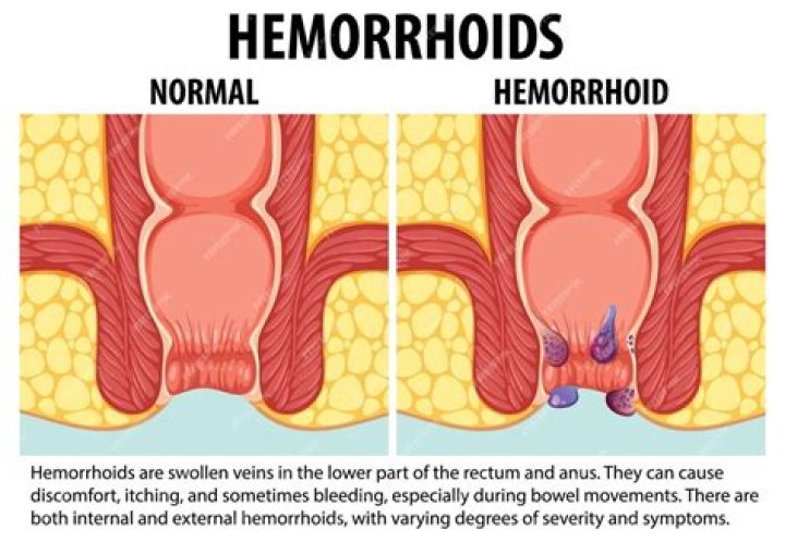 What happens if a hemorrhoid is left untreated?