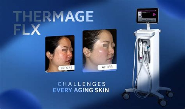 What Is Thermage FLX? What to Know About the New Skin Tightening Treatment