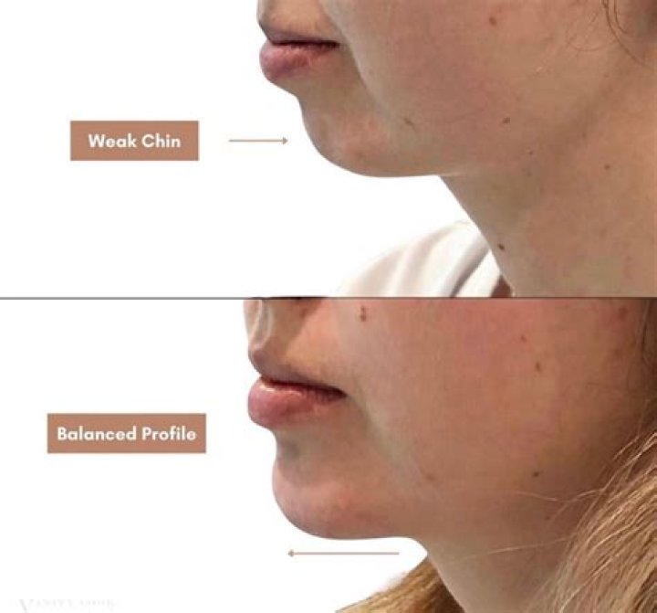 Why is my chin disappearing?