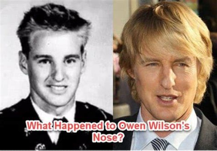 Why is Owen Wilson’s face like that?
